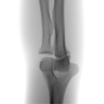 Elbow X-ray image
