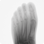 Foot X-ray image