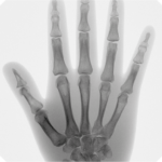 Hand X-ray image