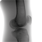 Elbow X-ray image