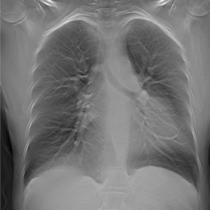 chest-tomosynthesis2